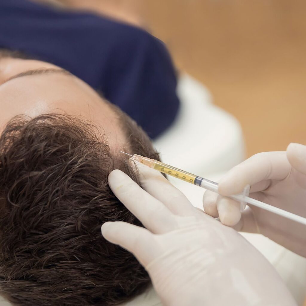 Mesotherapy For Hair Fall - n7aesthetics
