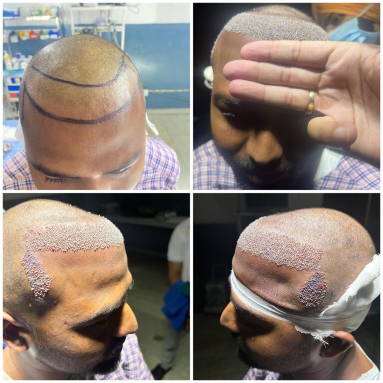 Before after hair transplant