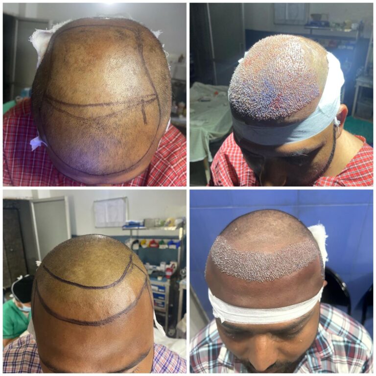 Hair Transplant service in Chandigarh