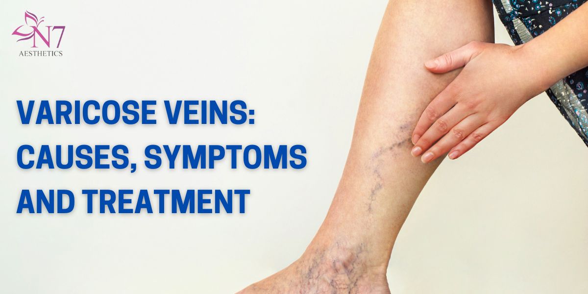 Varicose Veins Causes, Symptoms and Treatment