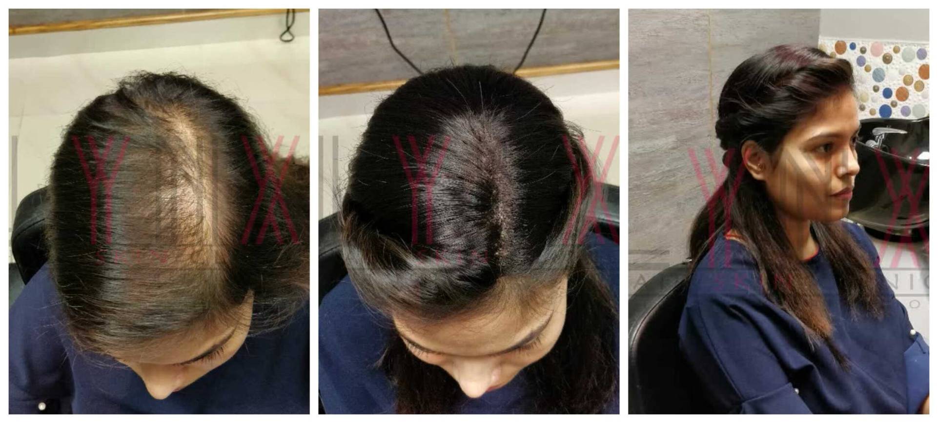 female hair loss chandigarh