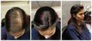 female hair loss chandigarh