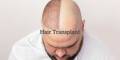 Hair Transplantation