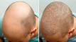 Baldness problem