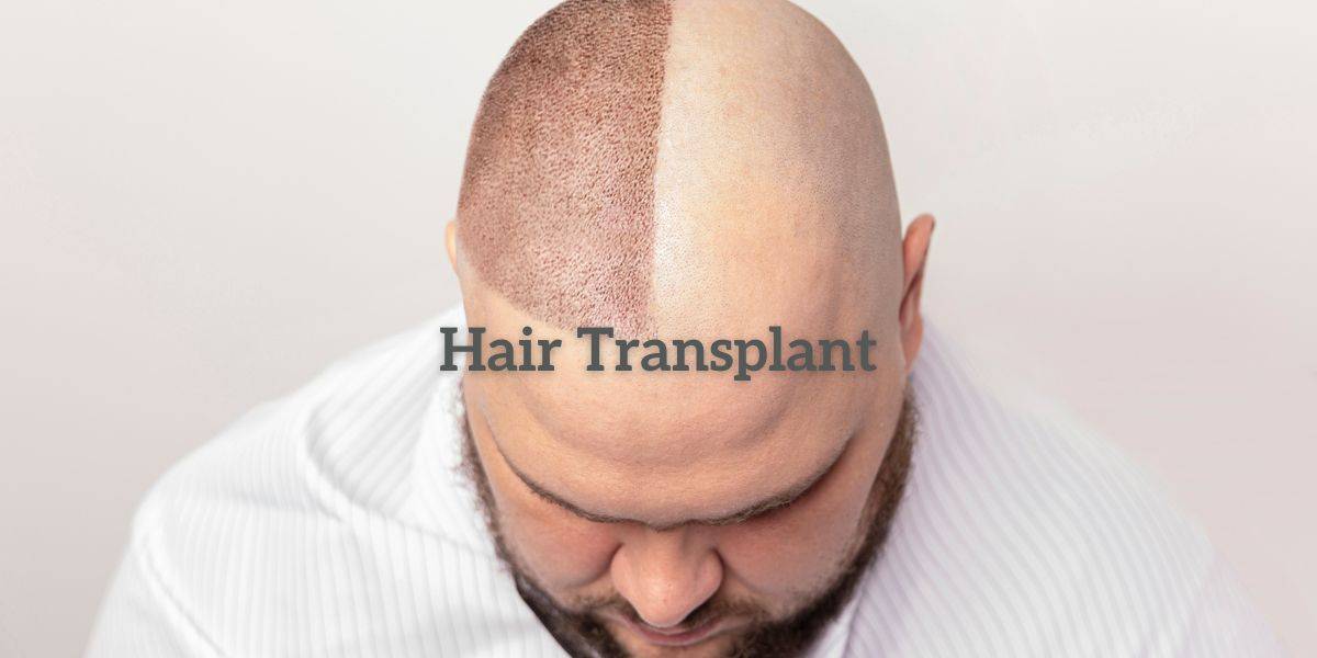 Hair Transplantation