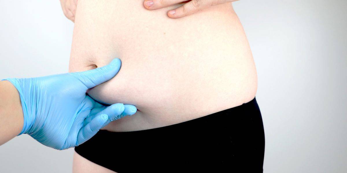Abdominoplasty 