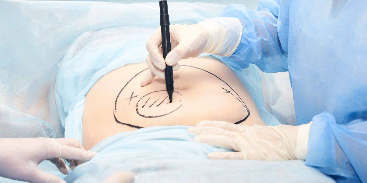 Liposuction