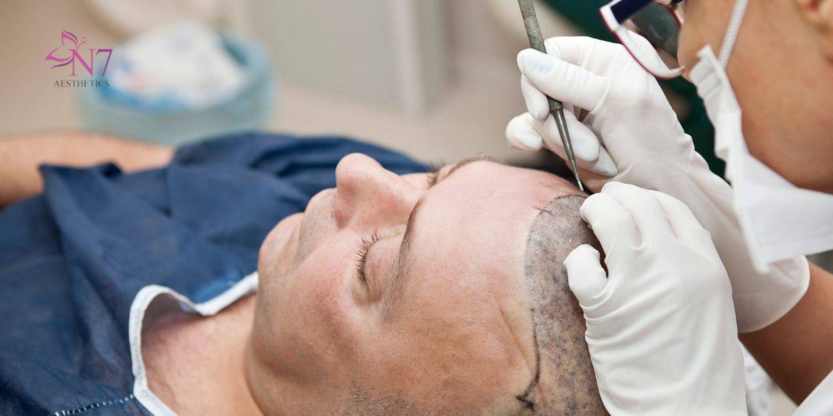 Fue hair transplant