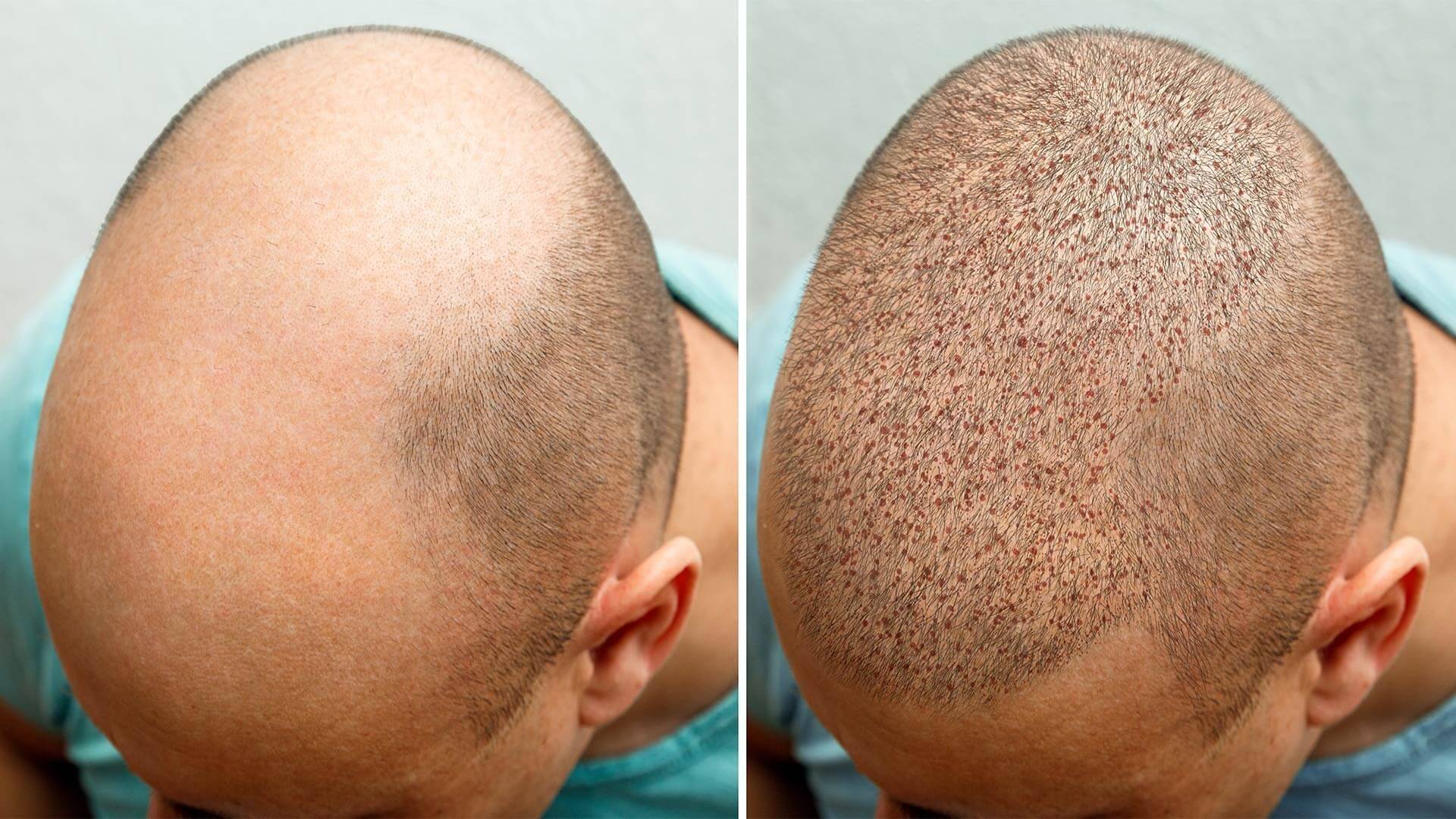 Baldness problem