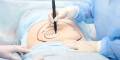 Liposuction - n7aesthetics (1)