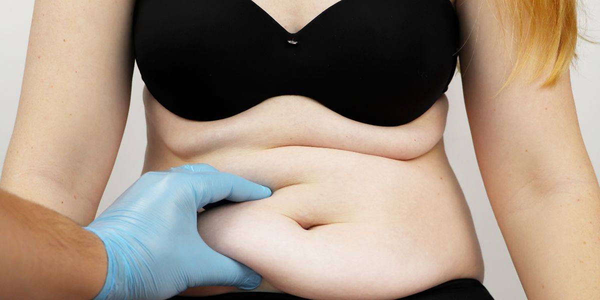 Mini Abdominoplasty